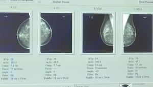 Multidisciplinárny tím v Nových Zámkoch zrýchľuje diagnostiku a operácie karcinómu prsníka