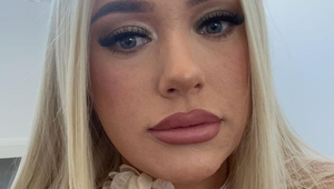 Aj takto môže vyzerať rakovina kože: Myslela si, že je to len upchatý pór