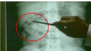 Z Madridu na Slovensko pašoval drogy. Ukrýval ich vo vlastnom tele