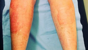 Pozor, z trhu sťahujú známy krém na lepšie hojenie poškodenej pokožky