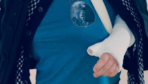 Lyžovačka skončila zle pre známeho českého režiséra! Má dolámané obe ruky!