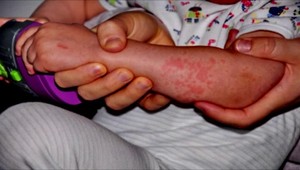 Osýpky, mumps či rubeola. Sme dostatočne zaočkovaní?