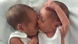 Dávali im iba 10-percentnú šancu na život: Identické dvojičky dnes hviezdia v modelingu