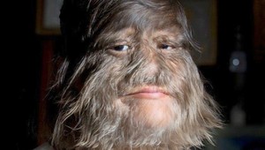 Šokujúca premena: Vlčia žena sa zbavila ochlpenia a ukázala svoju tvár