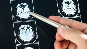 Známy liek môže znížiť riziko demencie až o polovicu