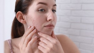 Prekvapivé zistenie o akné: Odborníčka tvrdí, že TO má jednu veľkú výhodu