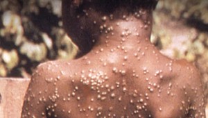 Prvé podozrenie na opičie kiahne hlási aj Rakúsko. Vedci sa obávajú, že prípadov vo svete bude pribúdať