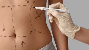 Šokujúce priznanie plastických chirurgov: Tieto zákroky by nikdy nepodstúpili