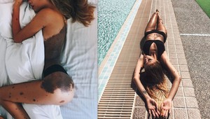 Krásku z Instagramu ponižovali kvôli obrovskému materskému znamienku