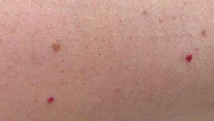 Prečo vznikajú na tele takéto červené bodky? Ak ich máte aj vy, TOTO by ste mali vedieť!