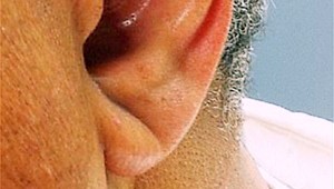 Čiara na uchu môže byť signálom hroziacej mŕtvice