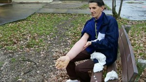 Amputácia ruky. Košičan si ju chce odrezať sám pílkou