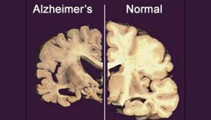 Alzheimera môže rýchlo a včas odhaliť test slín
