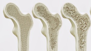 Ak patríte do týchto 11 skupín žien, ste náchylnejšia na osteoporózu!