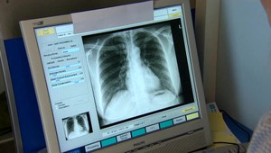 Môžete dostať dve rakoviny súčasne? Podľa lekárov to nie je nezvyčajné