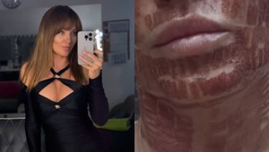 Alexandra Orviská šokovala vzhľadom po zákroku: TVÁR ako z hororu! TOTO fakt dala?!