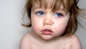 Ovčie kiahne v dospelosti môžu spôsobiť výrazné problémy