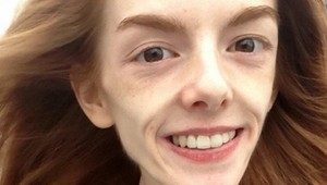 Pohľad na jej telo vás zabolí: Ako skončilo dievča, ktoré sa vyhladovalo na 29 kíl?