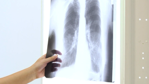 Revolúcia v liečbe rakoviny pľúc: Britskí vedci na zákernú chorobu chystajú vakcínu