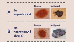 Dajte si po lete prezrieť kožu. Melanóm postihuje aj ľudí, ktorí sa neopaľujú!
