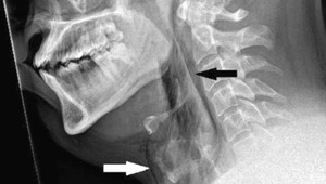 Potvrdené: Zadržiavanie kýchnutia môže byť životu nebezpečné