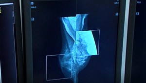 Nepríjemné zistenie vedcov: Hormonálna antikoncepcia môže súvisieť so zvýšeným rizikom rakoviny prsníka