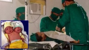 Dvojhlavé dieťa: Lekári nevedia, ktorú z hlavičiek zachrániť