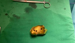 Unikátna operácia: Bratislavskí lekári nahradili pätovú kosť dieťaťu s rakovinou