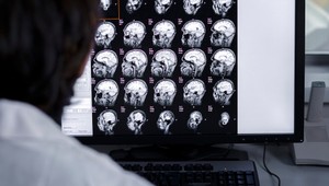 Štúdia o následkoch COVID-19: Preukázané poškodenie mozgu