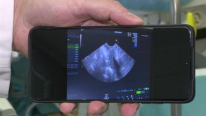 Ružinov zavádza novú liečbu myómov. Čo je rádiofrekvenčná ablácia?