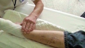 Kmeňové bunky ako záchrana pred amputáciou. Prvá poisťovňa už preplácanie liečby odobrila