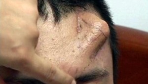 Infekcia mu poškodila nos, nový vypestovali na čele