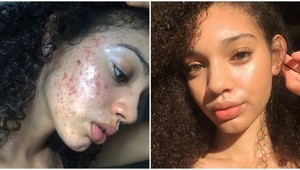 Ukázala, ako sa zbavila akné a ľudia jej ďakujú: Základom je táto domáca MASKA!