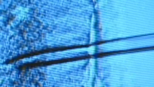 Terapia kmeňovými bunkami môže znížiť riziko srdcového infarktu a cievnej mozgovej príhody