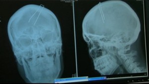 Mladík (23) si pri stavbe kôlne si strelil do hlavy klinec