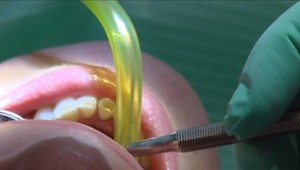 Pre koronavírus obmedzili prevádzky ambulancií aj zubári. Väčšine z nich chýbajú respirátory