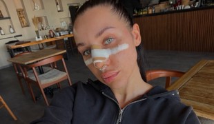 FOTO Bianka Rumanová je na nespoznanie! TAKTO vyzerá po operácii nosa