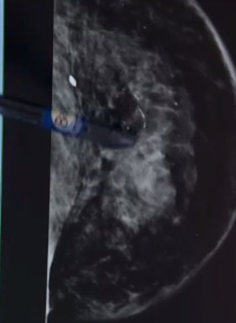 Nemajú nárok na mamograf