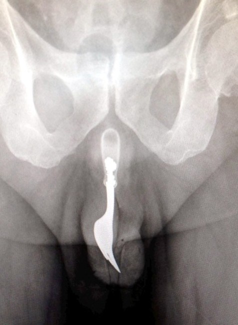 Rontgenový snímok fotografia vidlička penis sex