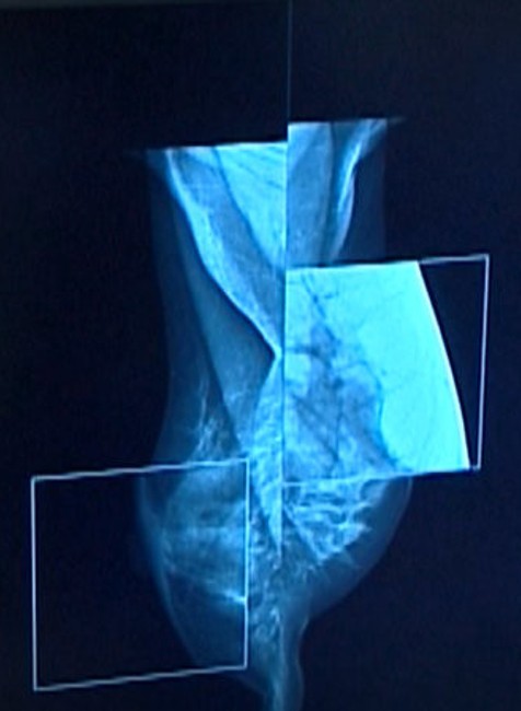 mamografia ultrazvuk