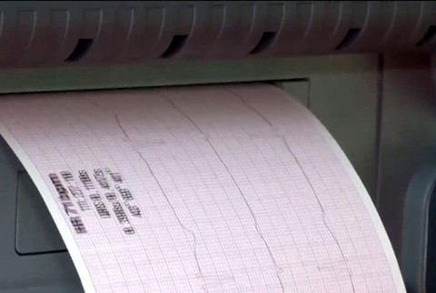 EKG