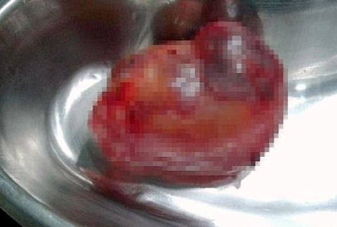 parazitujúce dvojča v plodovom obale