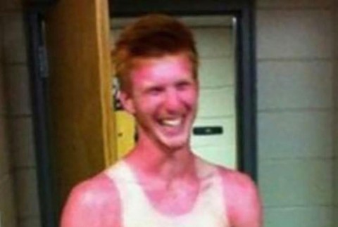 Nepodarené opálenie