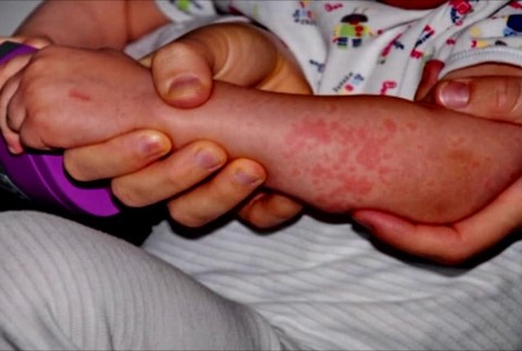 Poznáme stav imunity populácie