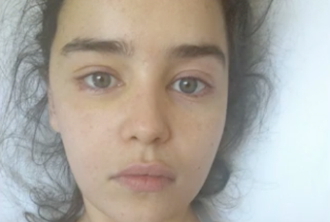 Emilia Clarke - operácia mozgu 2