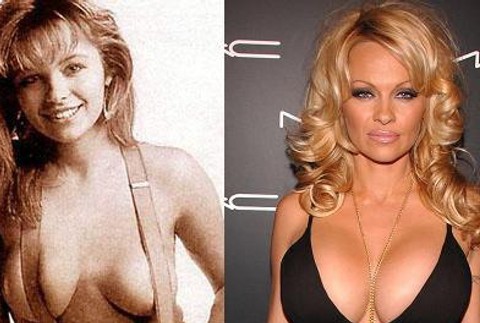 pamela anderson plastika