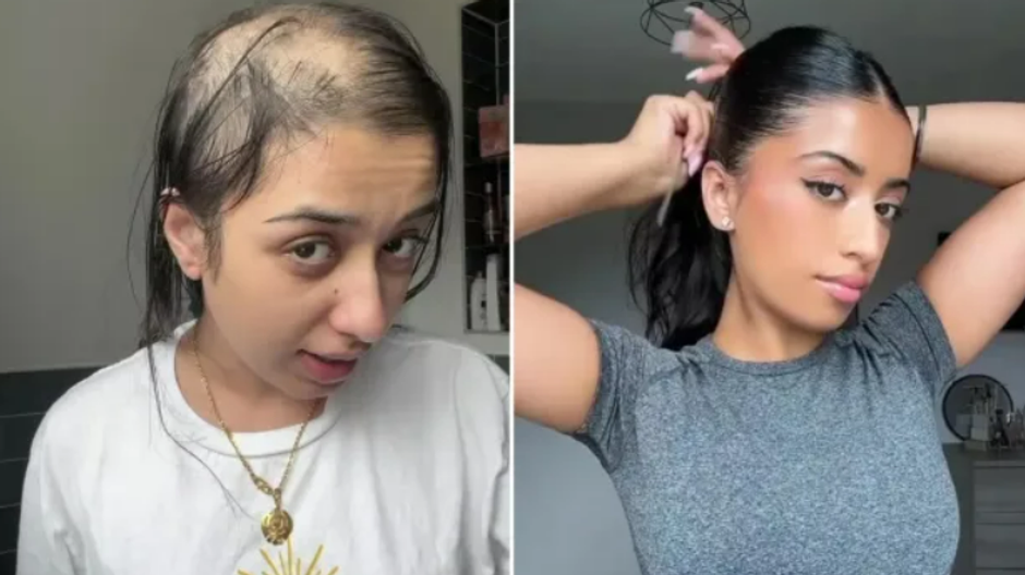 alopecia vypadavanie vlasov