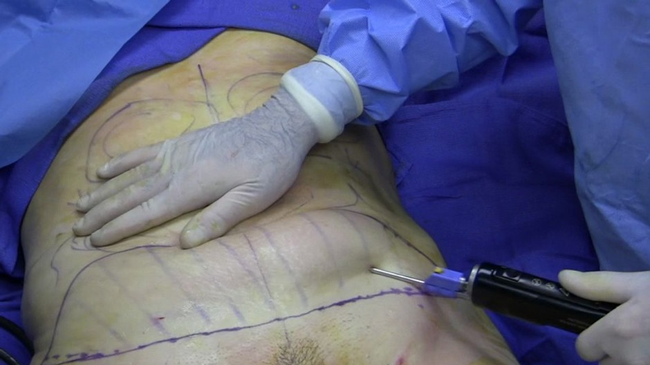 liposukcia operacia telo lekar ruka nastroj