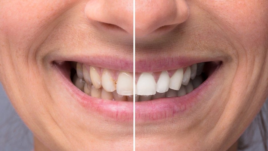 zuby, bielenie zubov