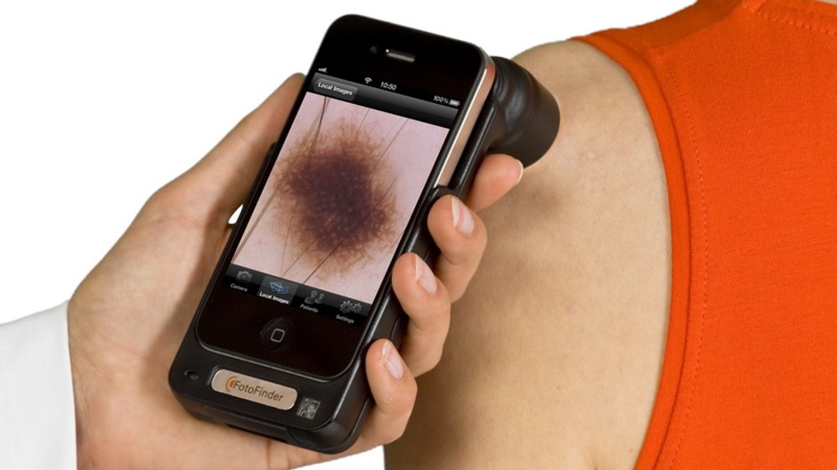 iPhone dokáže odhaliť rakovinu kože